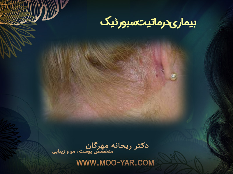 درماتیت سبورئیک(شوره یا پوسته ریزی سر)